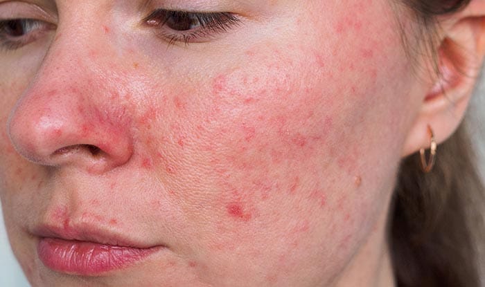 12174-rosacea